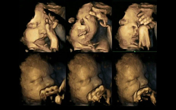 Unborn Baby, Mother smoking Unborn Baby, Mother smoking